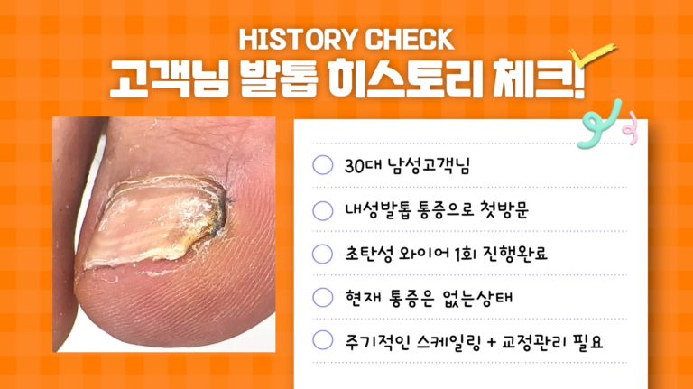 30대남자 내성발톱교정