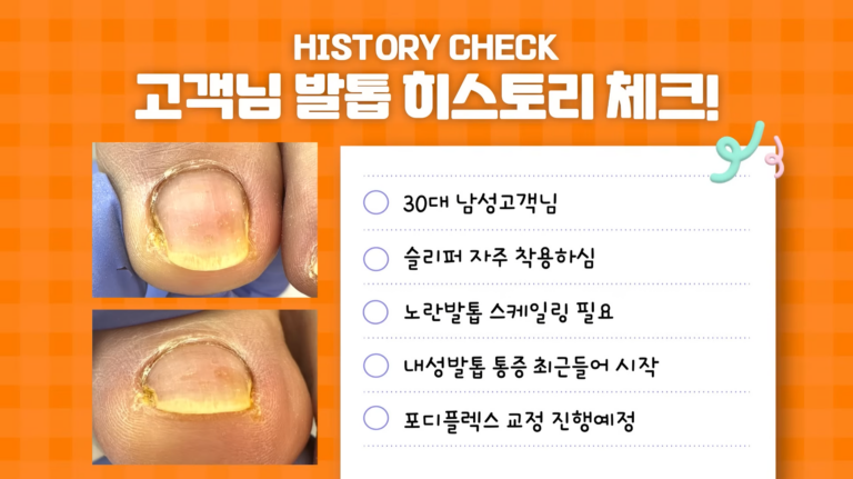 노랗고 파고드는발톱