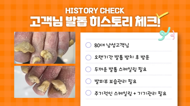 두꺼운발톱