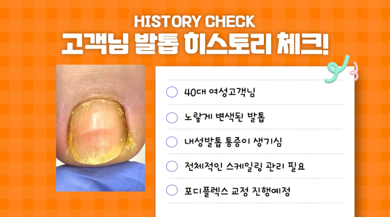 변색되고 파고드는 발톱