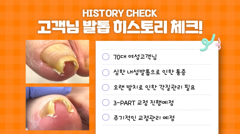 심한내성발톱관리