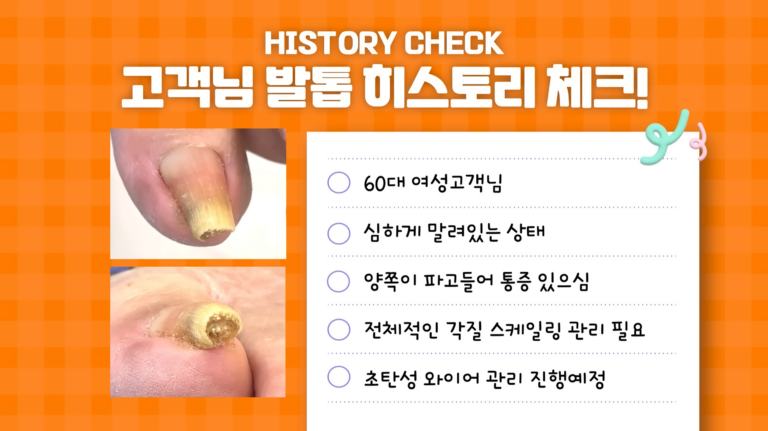 양쪽이 파고드는발톱