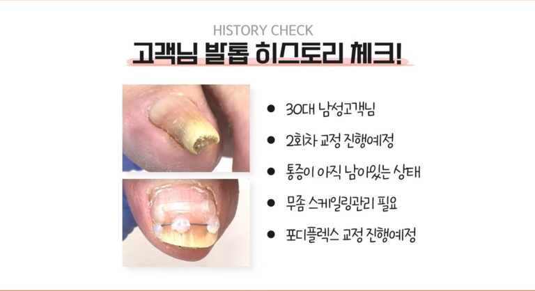 말리며 파고드는 발톱